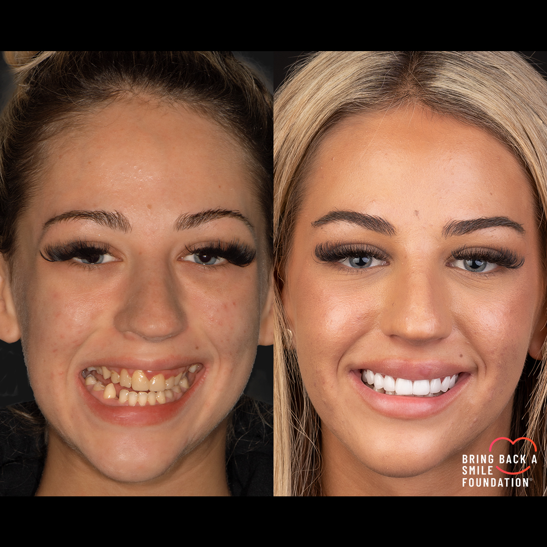 Isabella before and after smile makeover missing teeth at Bring Back a Smile Foundation