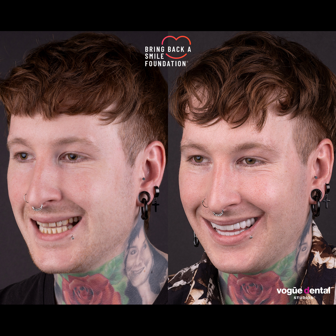 Nathan smile makeover before and after at Bring Back a Smile Foundation