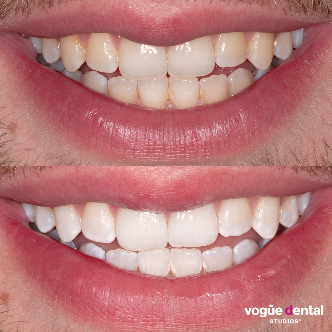 Before and after Philips Zoom professional in-chair teeth whitening at Vogue Dental Studios. Enes