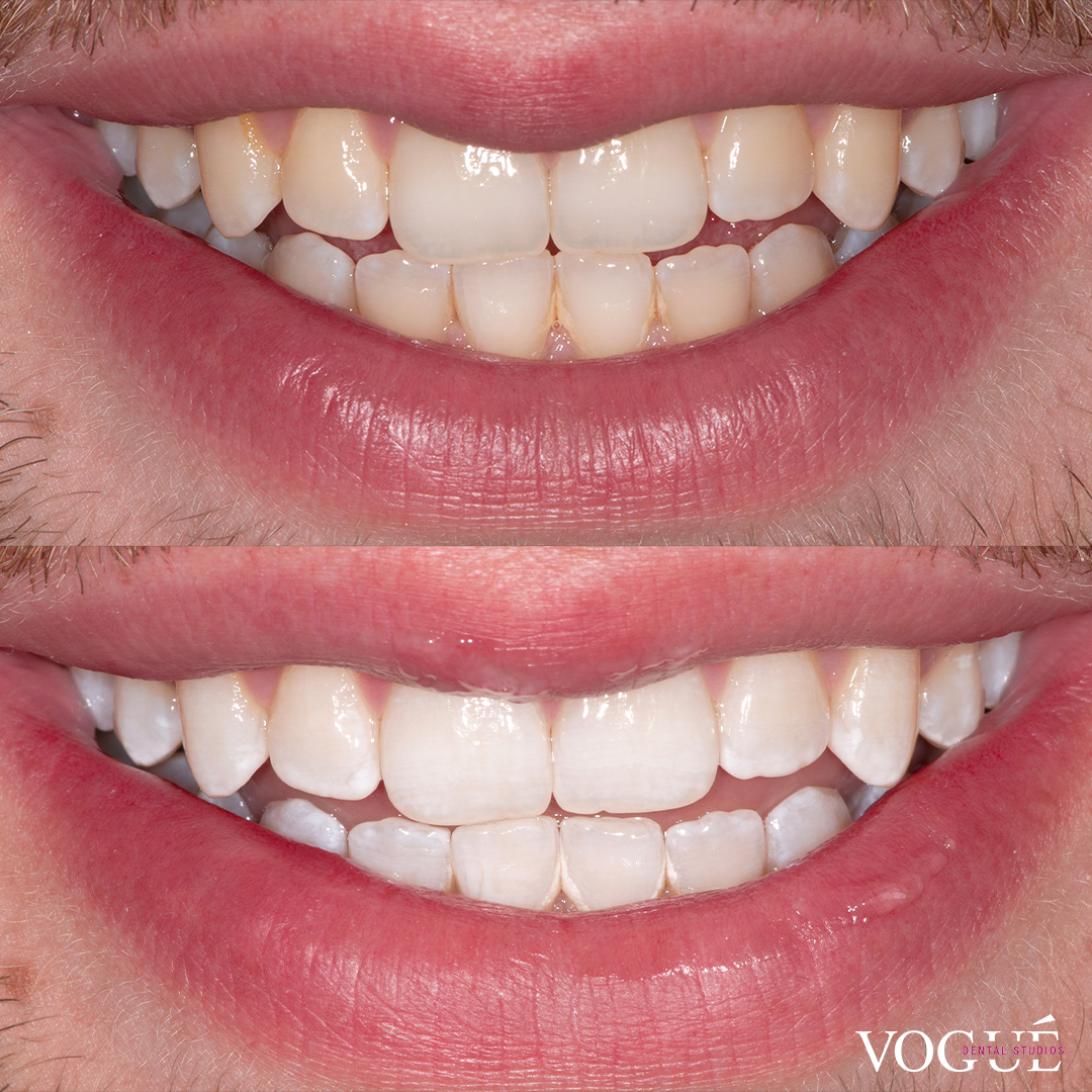 Before and after Philips Zoom professional in-chair teeth whitening at Vogue Dental Studios. 