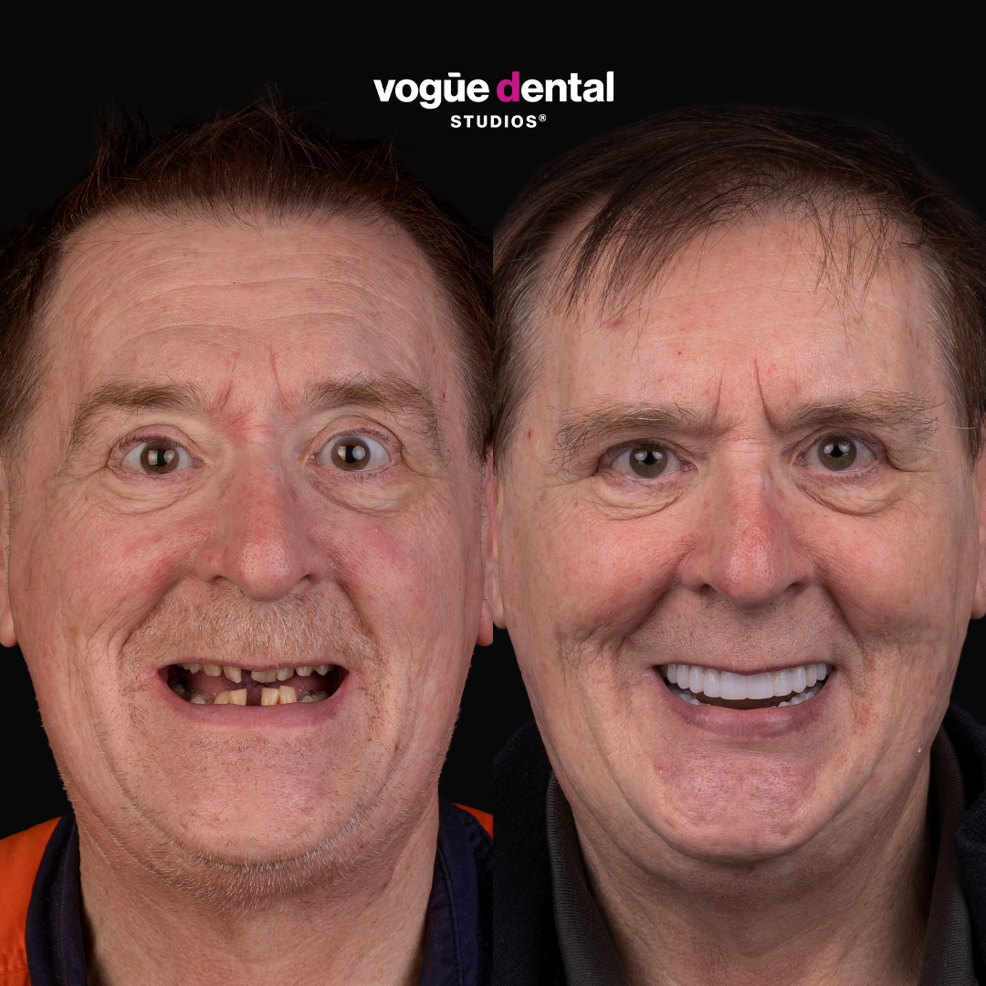 Before and after implant smile makeover at Vogue Dental Studios - front face view Damian