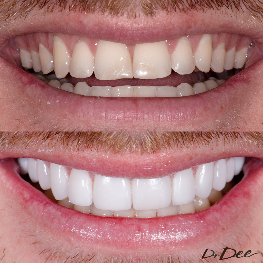 Bryce Ruthven upper porcelain veneers by Dr Dee and Dr Betty Matthews at Vogue Dental Studios.