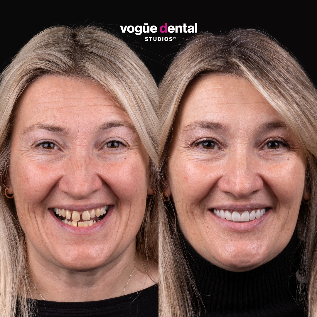 Before and after porcelain veneers at Vogue Dental Studios - full face view Anita