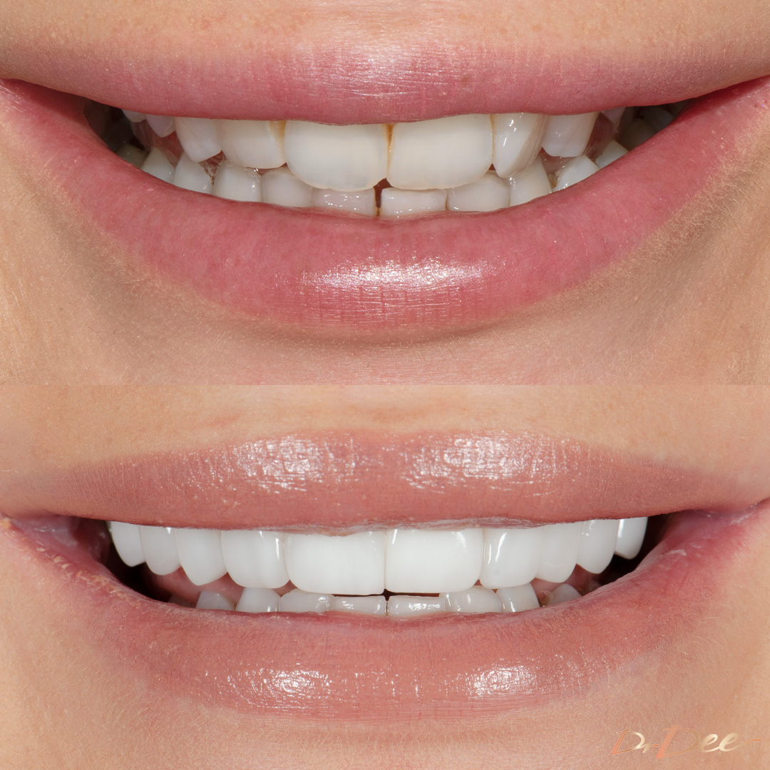 Melbourne Chippy Chick Stefanie porcelain veneers for narrow smile by Dr Dee