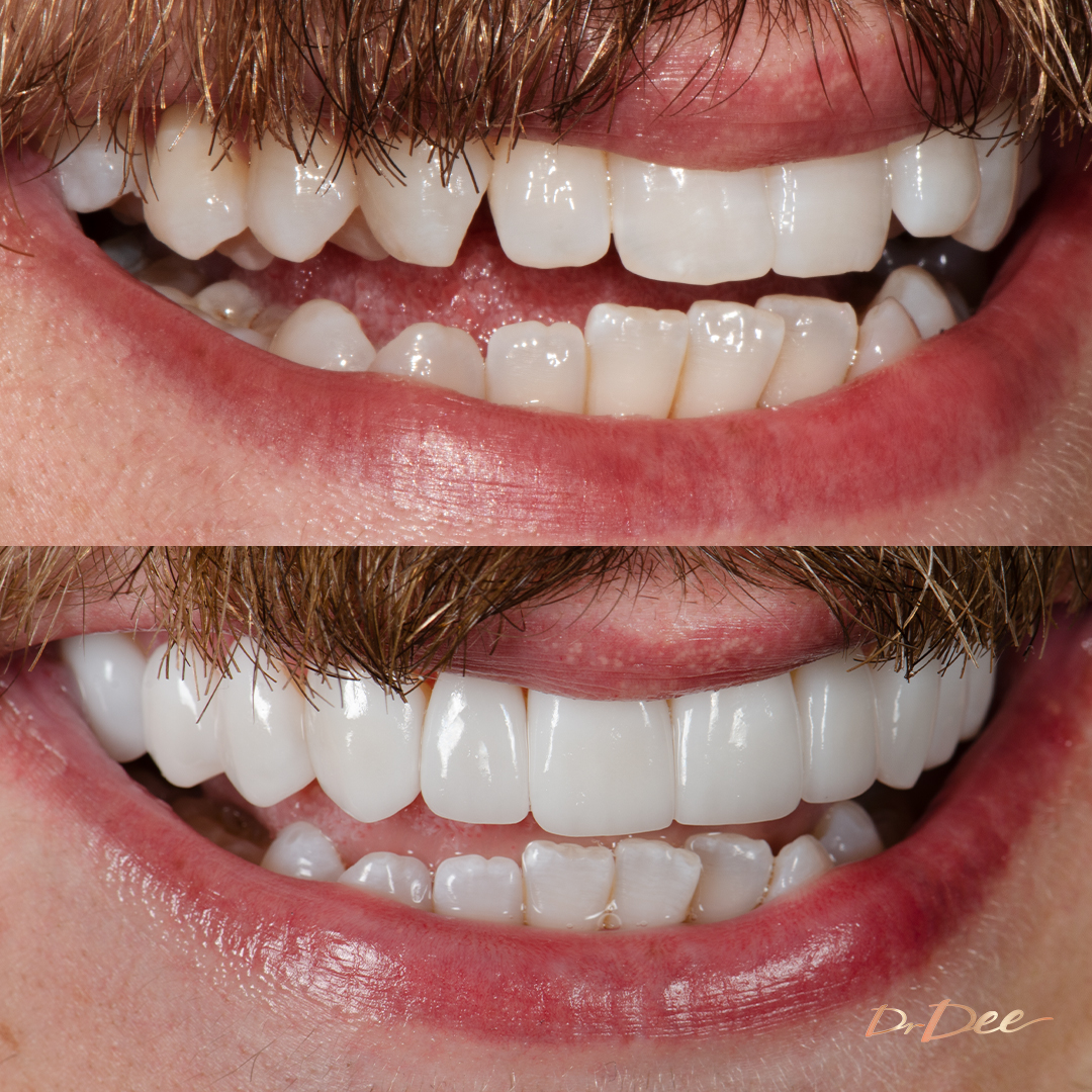 Before and after porcelain veneers at Vogue Dental Studios - Michael right teeth view