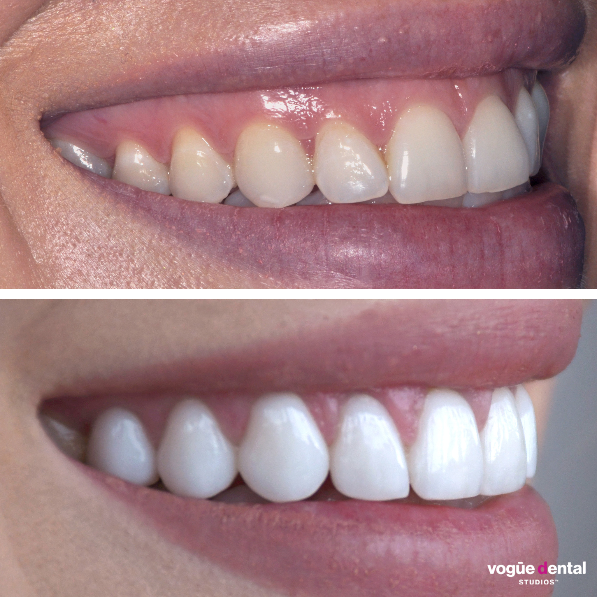 Before and after gummy smile and smile cant correction with porcelain veneers at Vogue Dental Studios - left view Cassie.