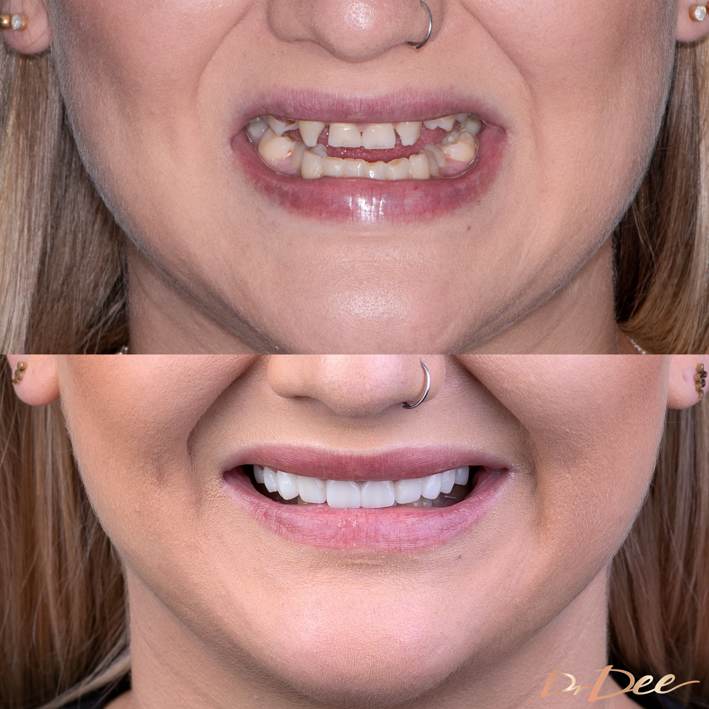 Shai before and after smile makeover for gappy smile at Vogue Dental Studios