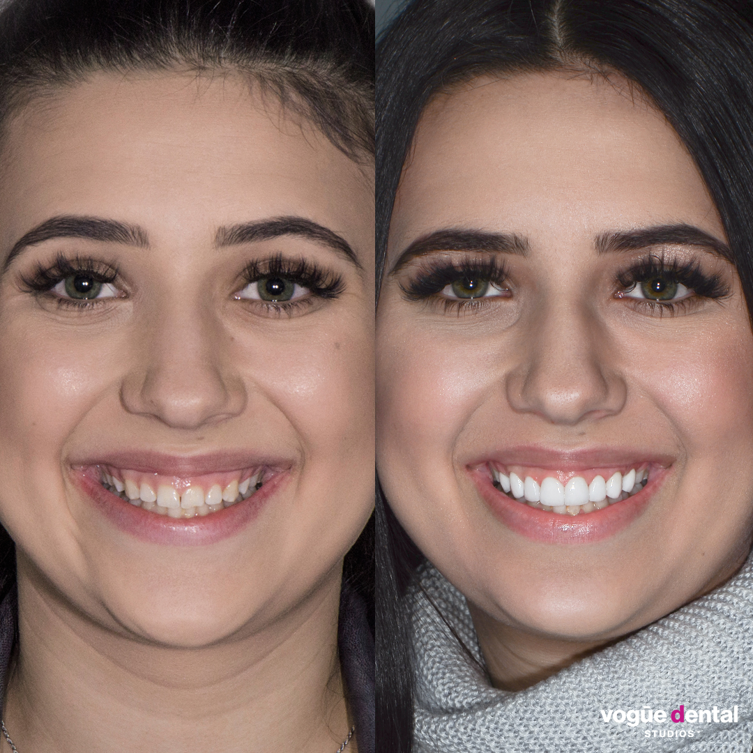Before and after gummy smile with porcelain veneers at Vogue Dental Studios - front face view Abi.