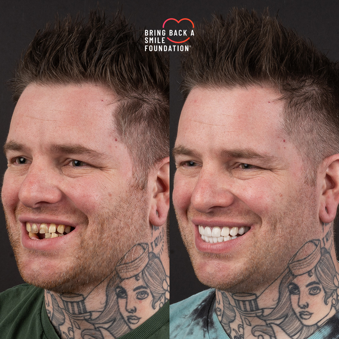 Before and after missing teeth with porcelain veneers at Vogue Dental Studios - side view Josh