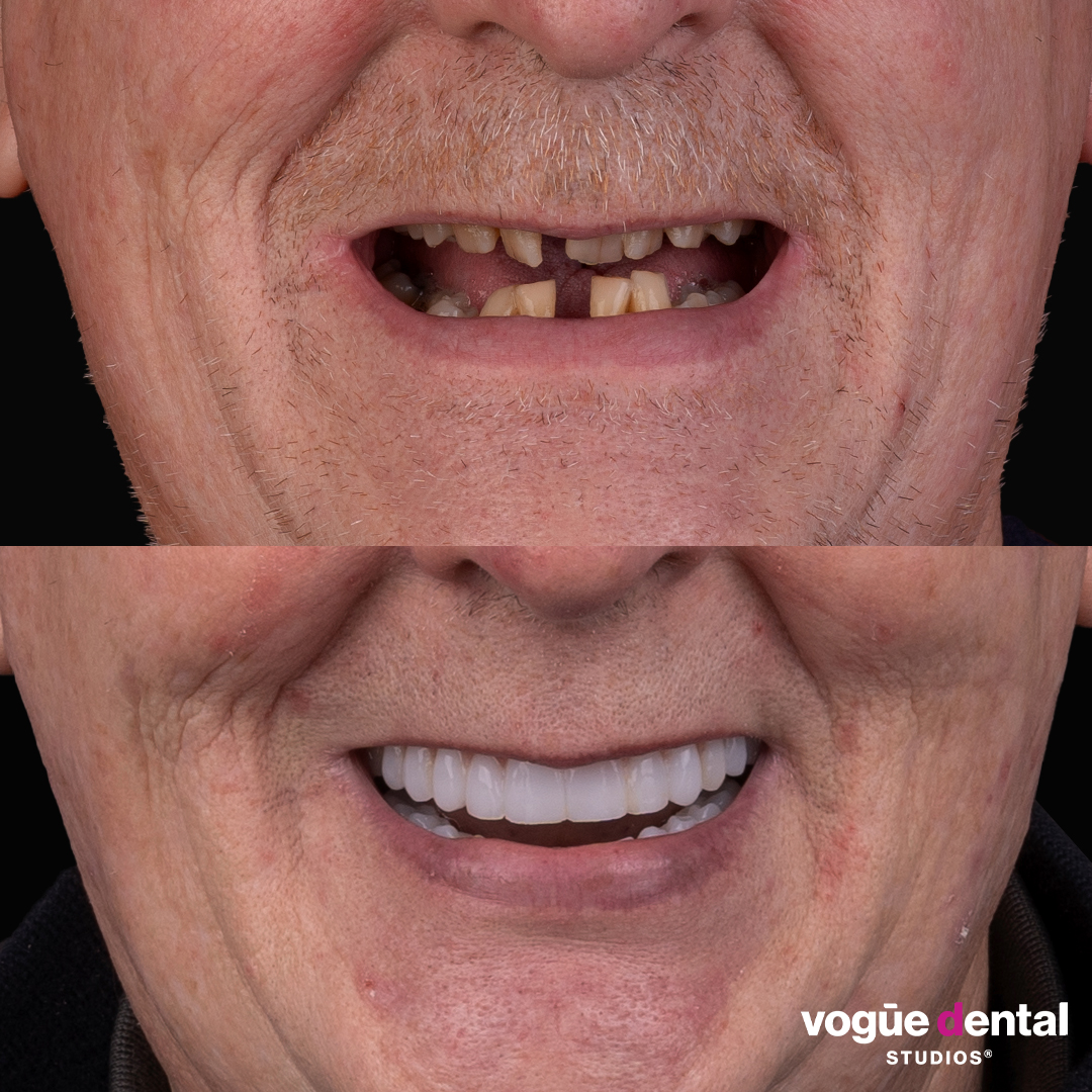 Before and after implant smile makeover at Vogue Dental Studios - front cropped view Damian