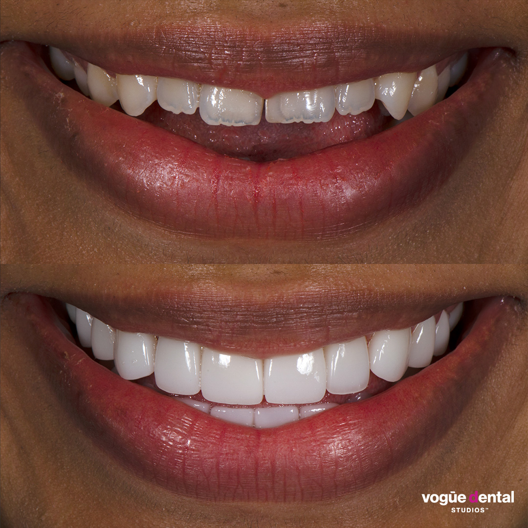 Before and after porcelain veneers smile makeover at Vogue Dental Studios - front teeth view Bhagya.