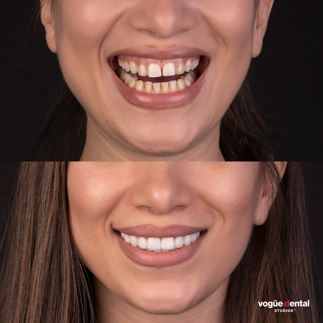 Before and after porcelain veneers at Vogue Dental Studios - close Face View Mina