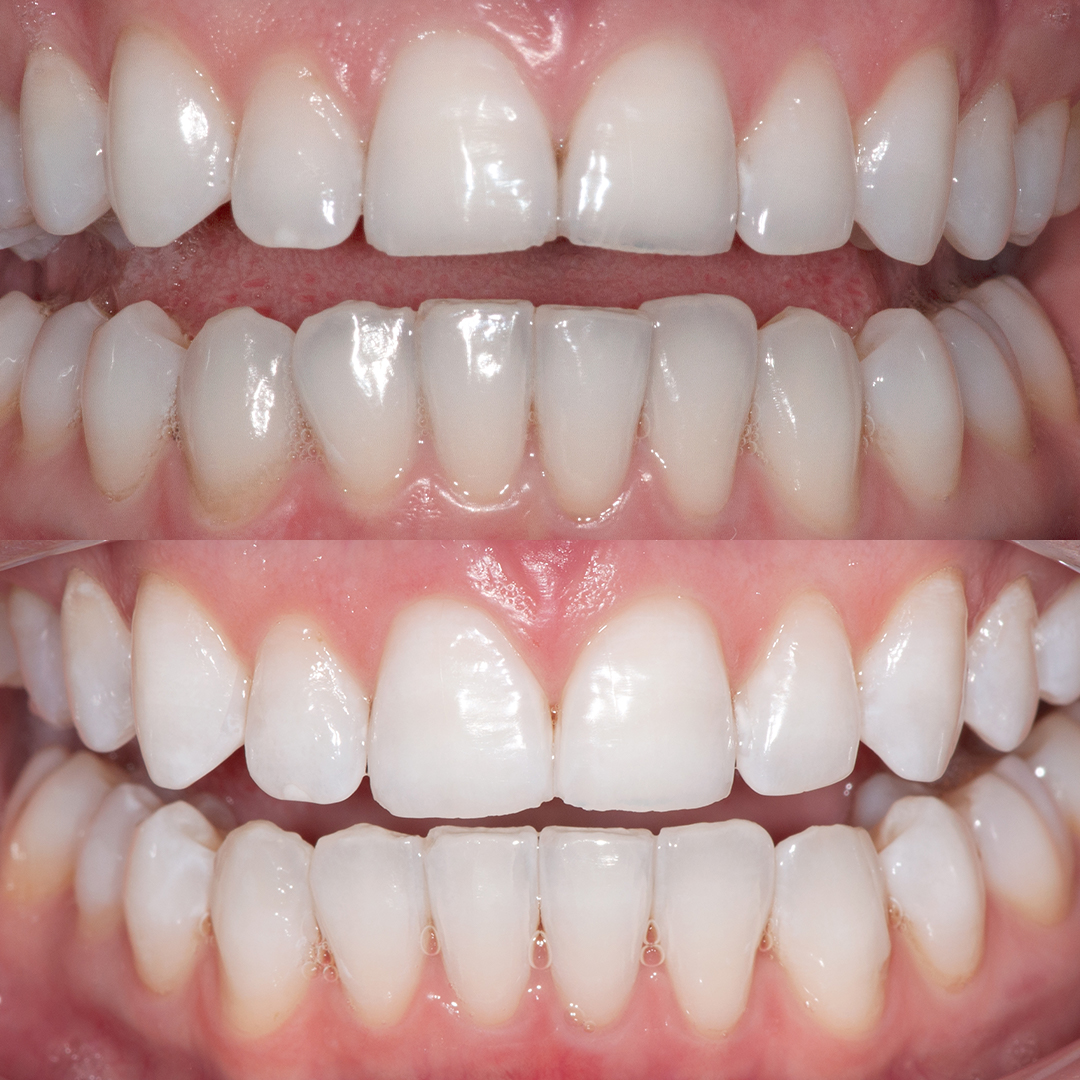 Before and after Invisalign Express at Vogue Dental Studios - front retracted view.