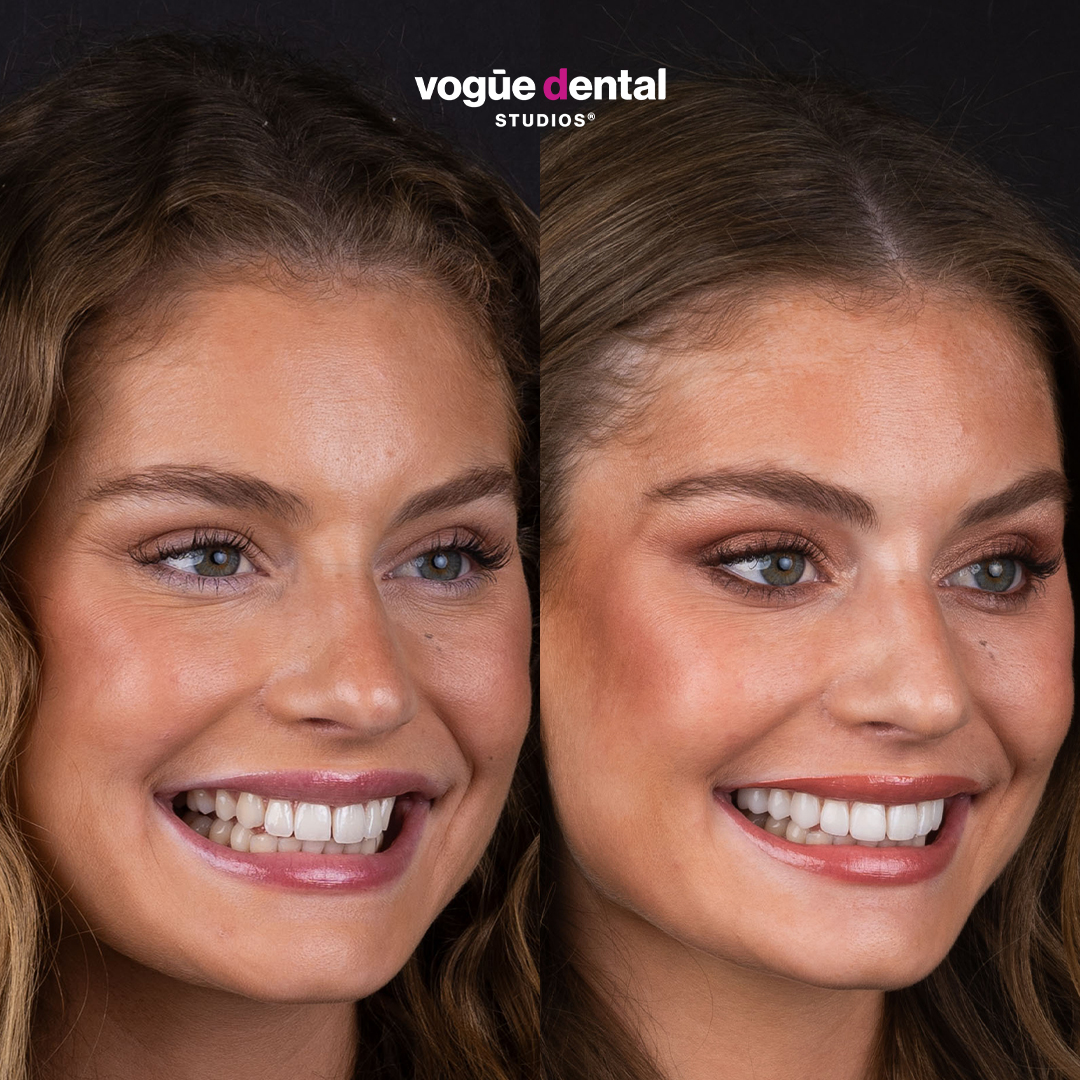 Moraya Wilson before and after porcelain veneers preserve gap in smile - right view