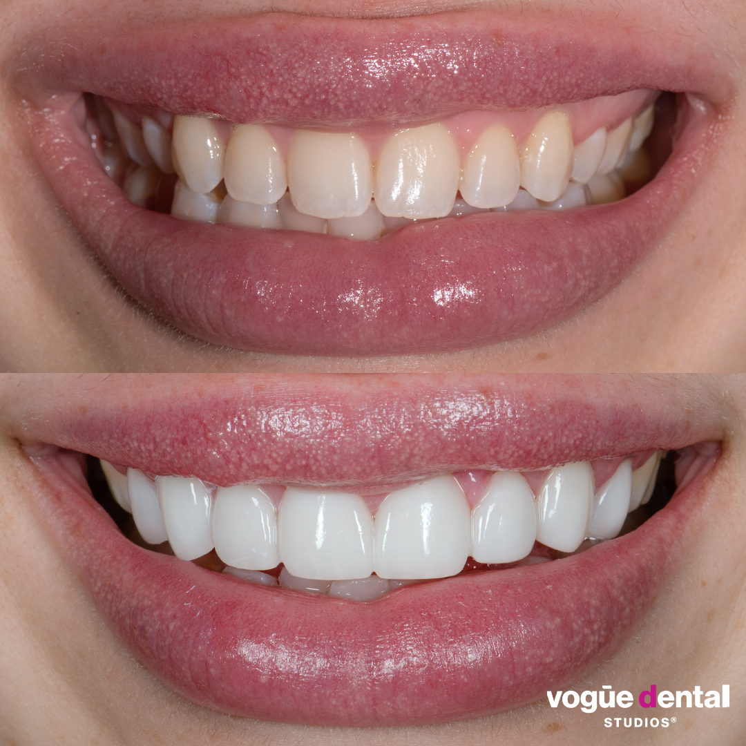 Kristina smile makeover with porcelain veneers at Vogue Dental Studios with Dr Dee.