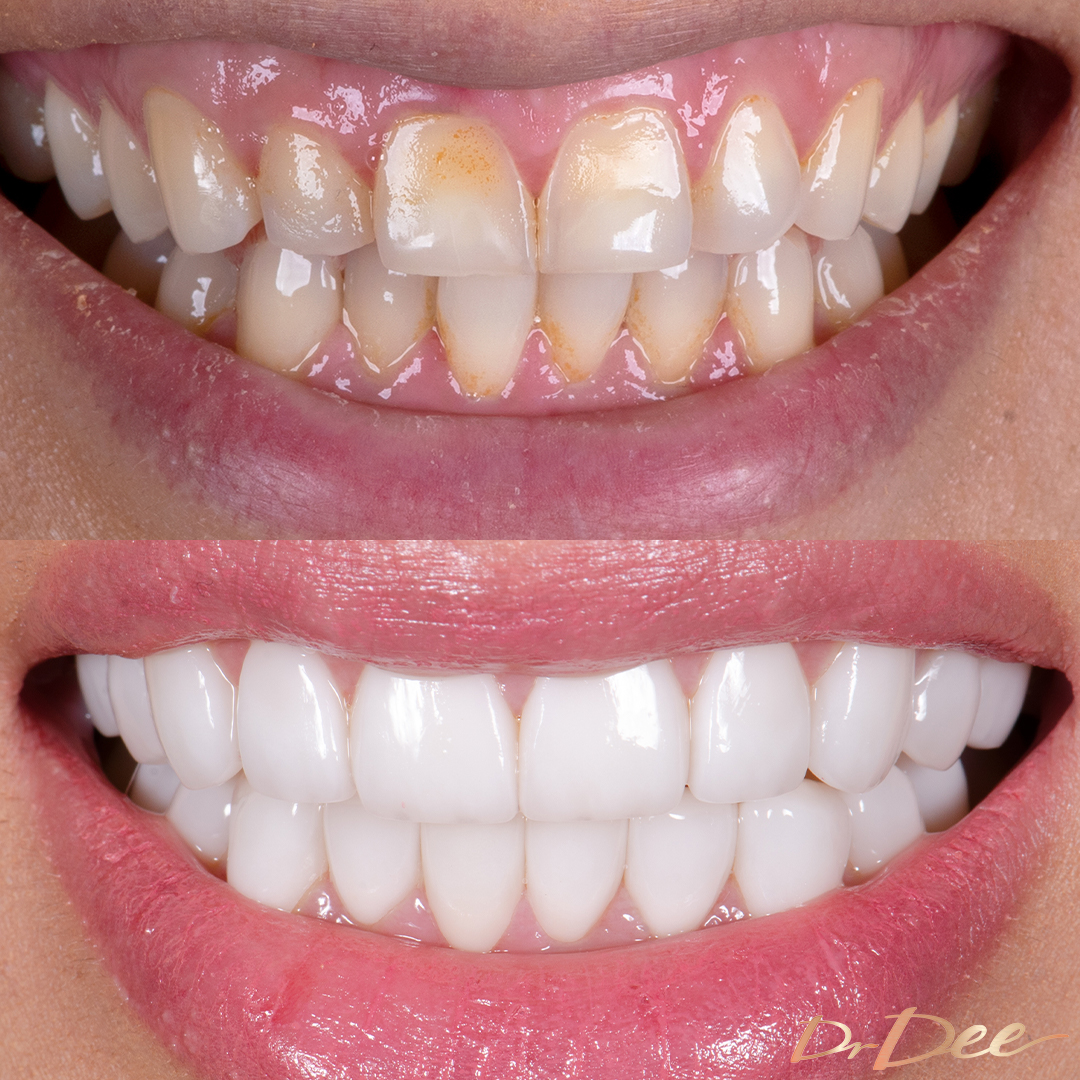 Before and after stained teeth with porcelain veneers at Vogue Dental Studios - front teeth view Niyoosha.