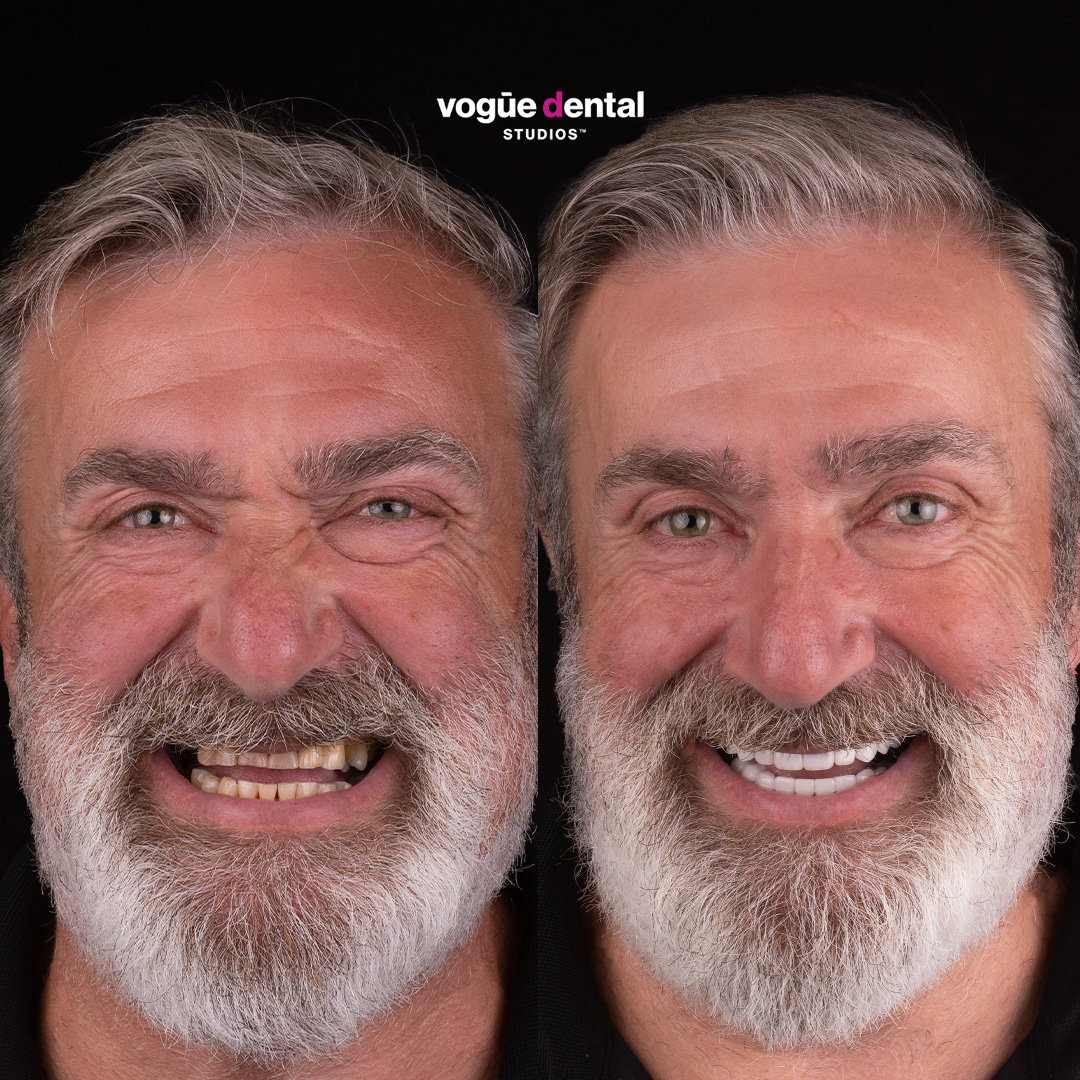 Before and after porcelain veneers at Vogue Dental Studios - Front View Theo