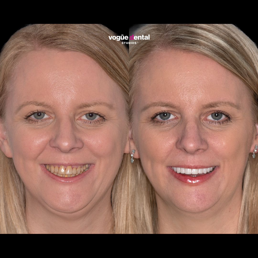 Alisha with Picasso Porcelain Crowns before and after