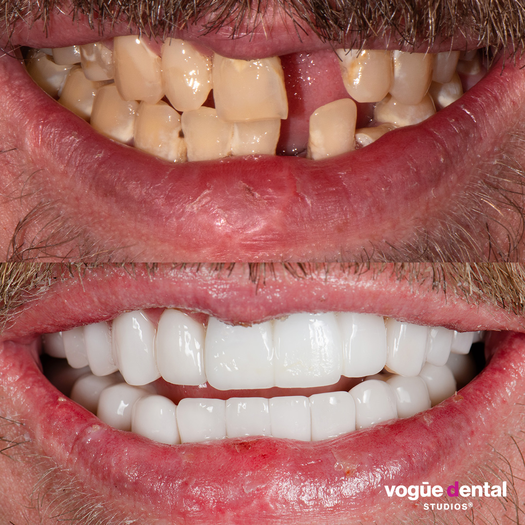 Before and after missing teeth with porcelain veneers at Vogue Dental Studios - Josh Waters front view