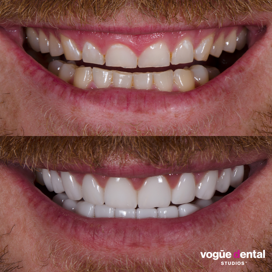 Before and after grinding bruxism with porcelain veneers at Vogue Dental Studios - in-progress Nick.