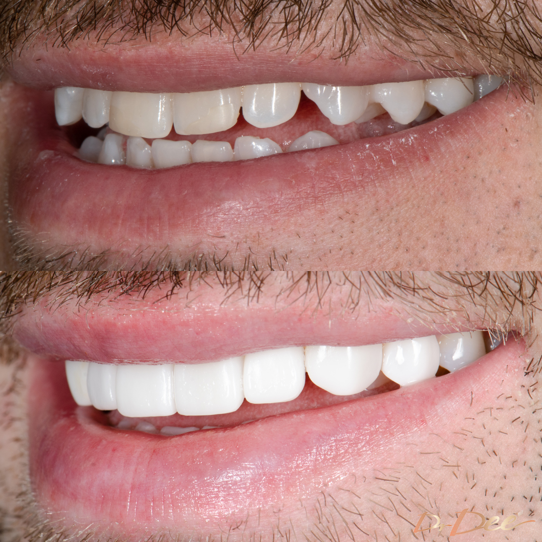 Before and after composite veneers revision by Dr Dee on Antoni Topic - left smile view