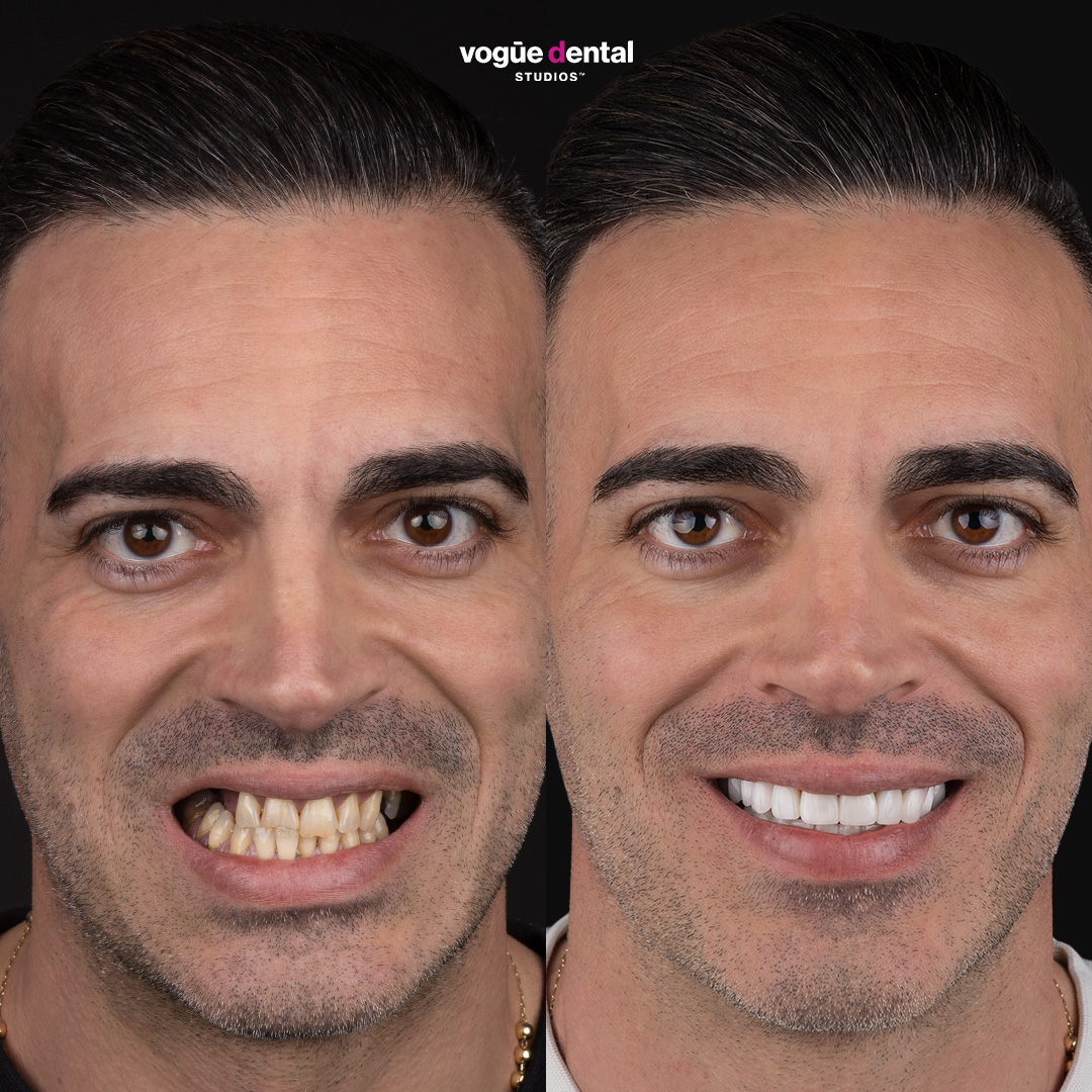 Before and after uneven smile with porcelain veneers at Vogue Dental Studios - front face Francesco