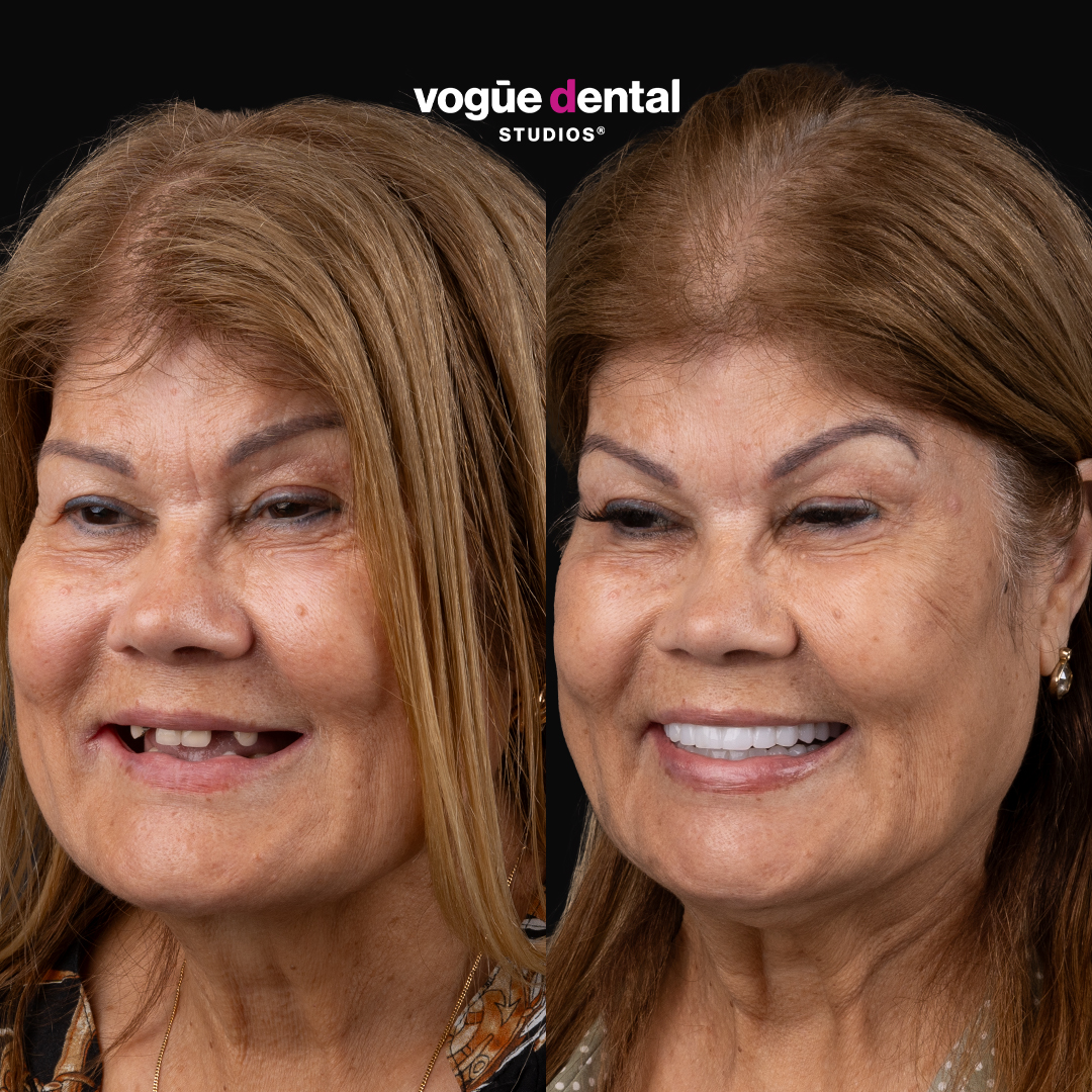 Before and after implant smile makeover at Vogue Dental Studios - side teeth view Doreen