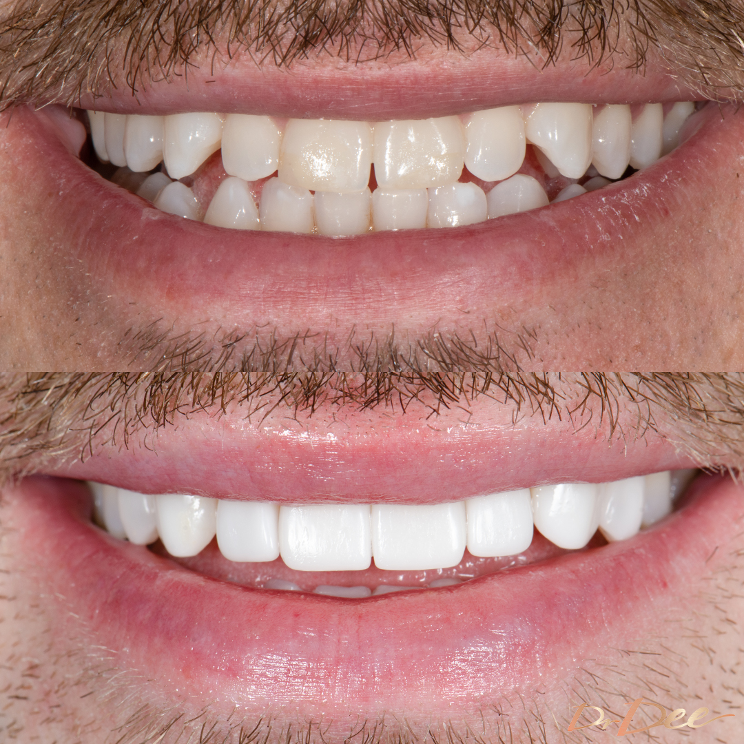 Before and after composite veneers revision by Dr Dee on Antoni Topic - front smileview
