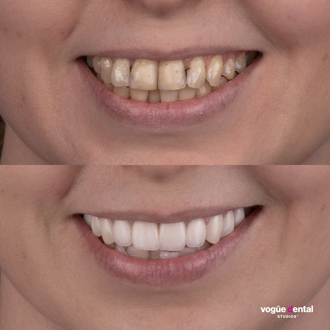 Elisabeth before and after thin enamel smile makeover Bring Back a Smile Foundation - front view