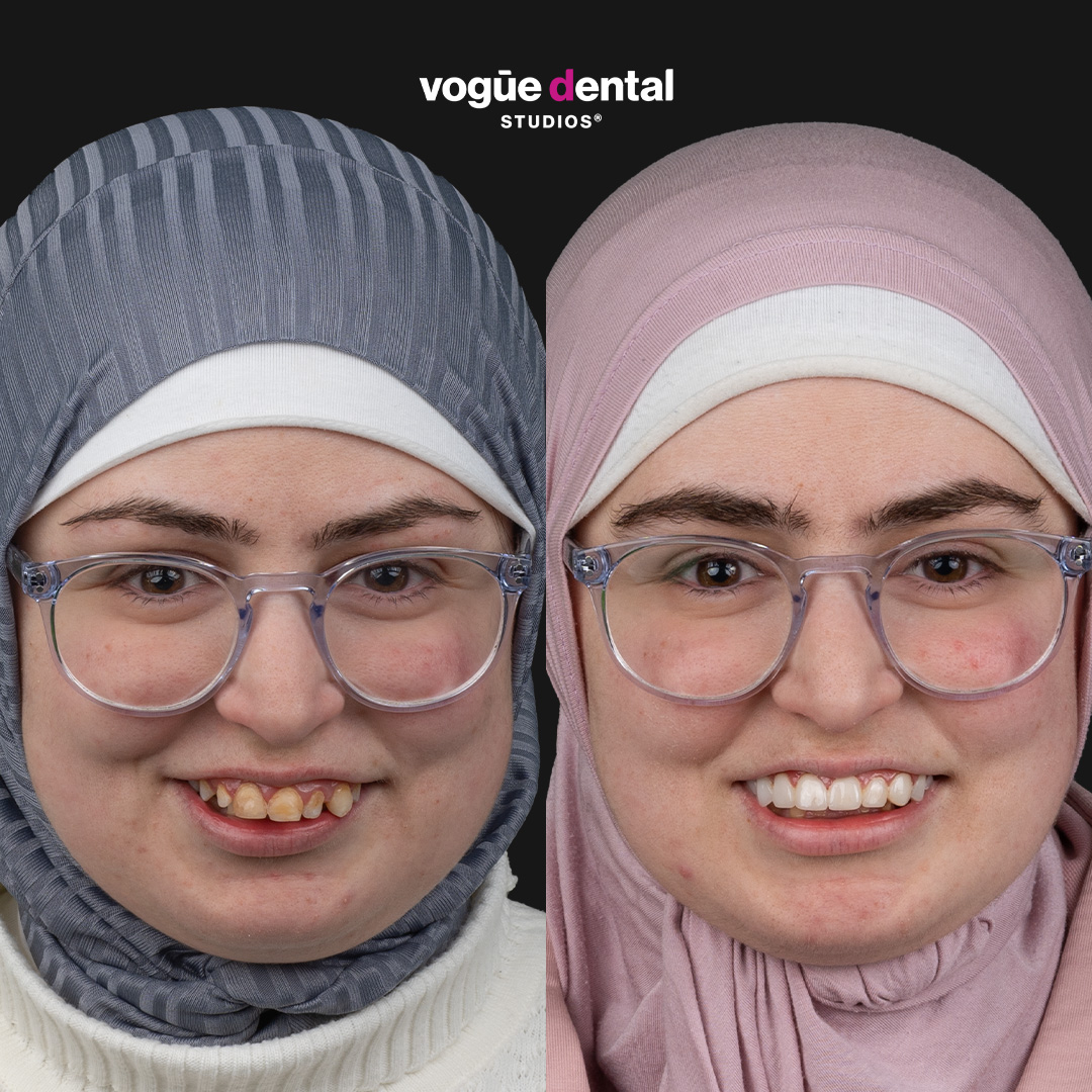 Rabab crooked teeth smile makeover before and after at Bring Back a Smile Foundation