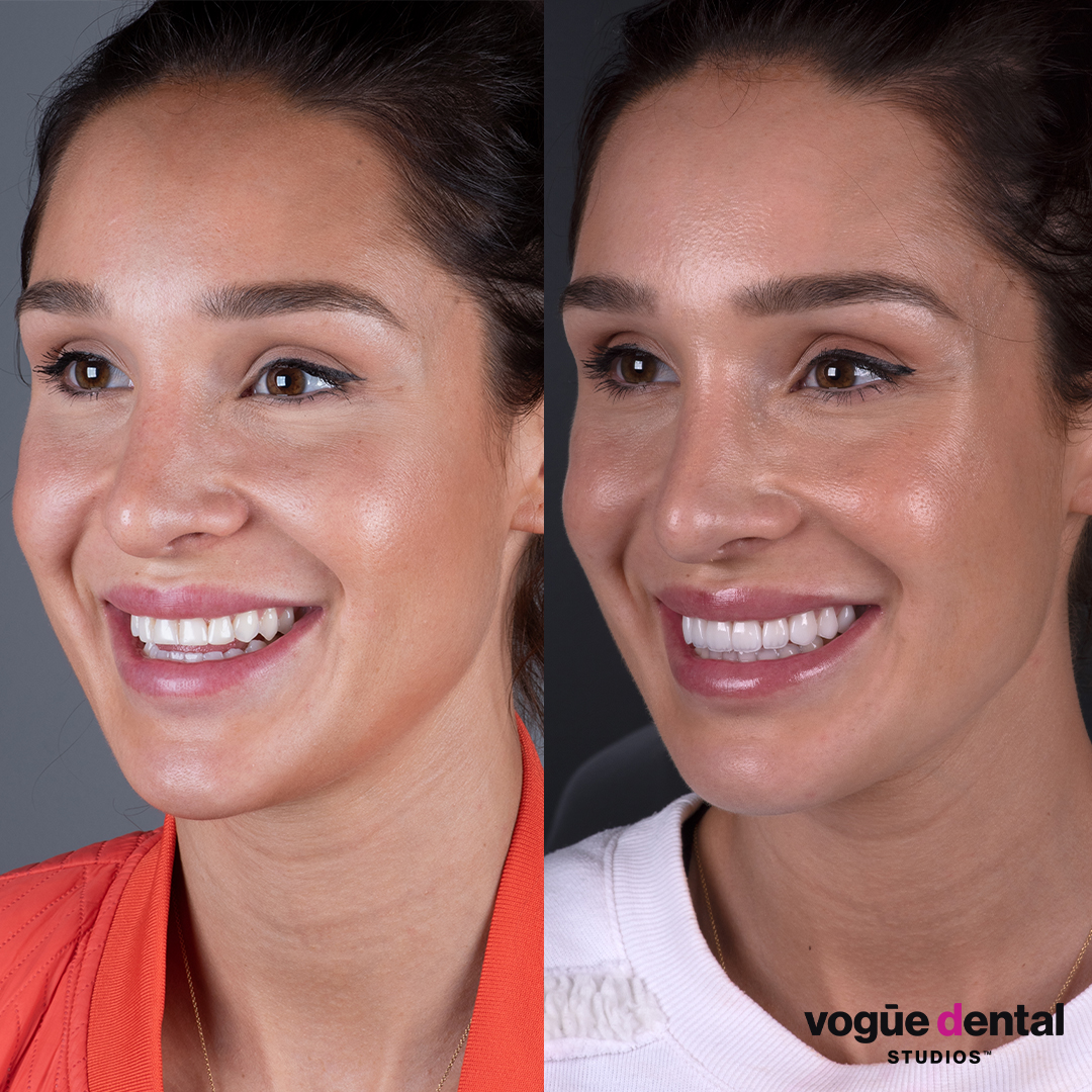 Kayla Itsines before and after porcelain veneers left full face view.