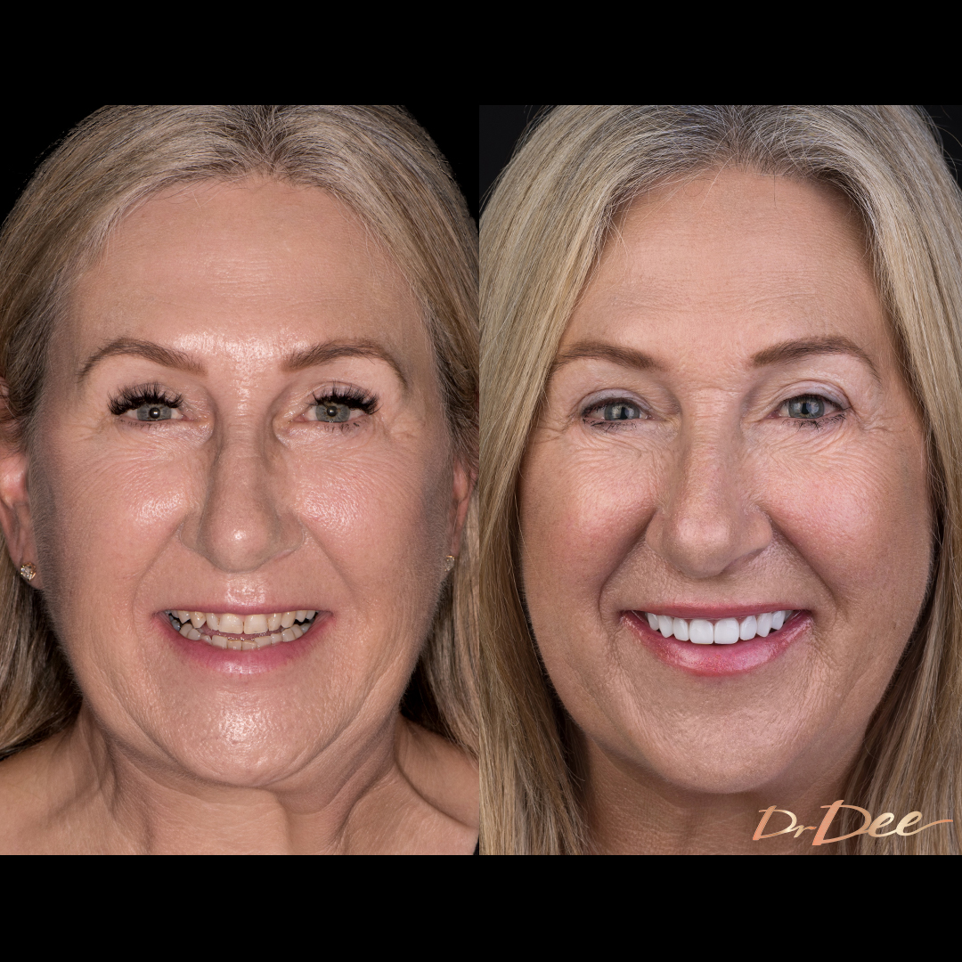 Before and after porcelain veneers at Vogue Dental Studios - front face view Annmarie