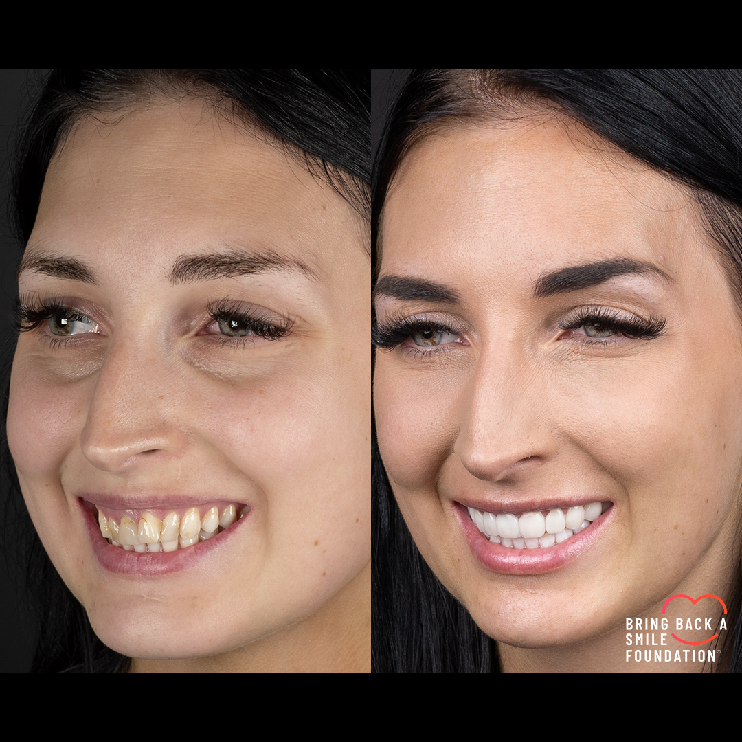 Shaan before after extraction braces and veneers with Bring Back a Smile Foundation