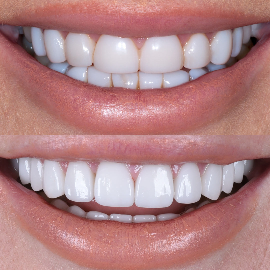 Before and after old composites with porcelain veneers at Vogue Dental Studios - front teeth view Keira Maguire.