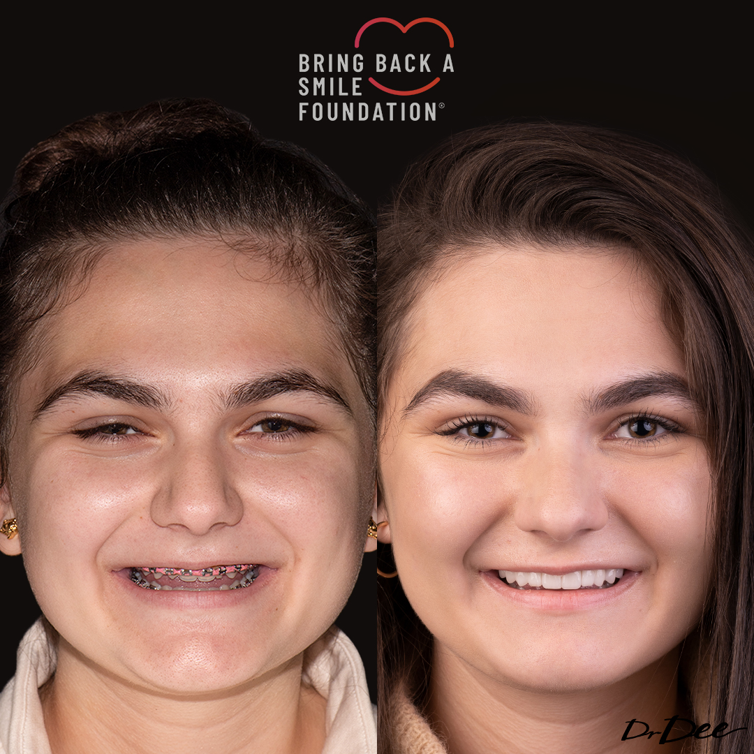 Bring back a smile foundation before and after veneers missing laterals