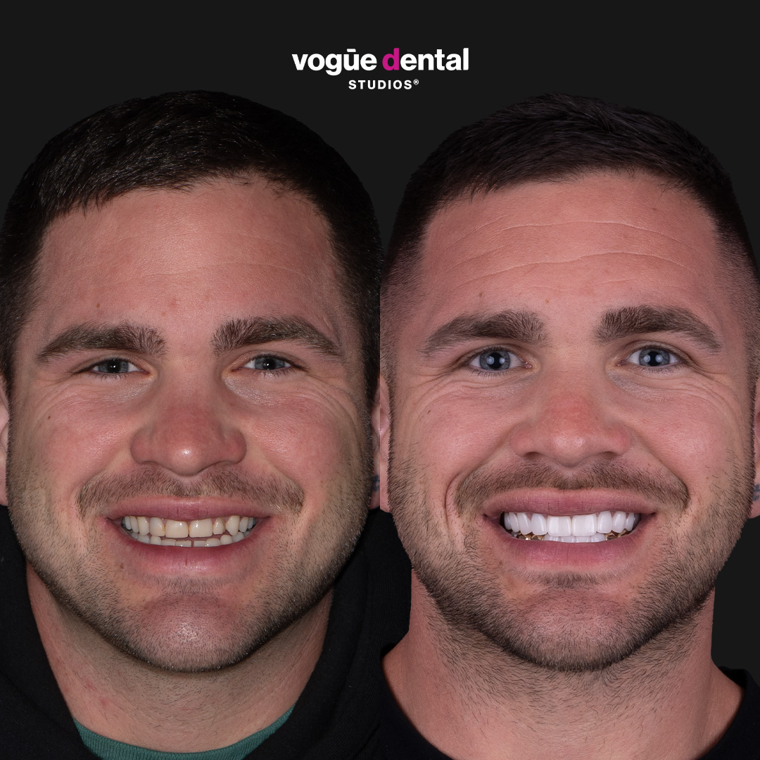 Before and after porcelain veneers and gold teeth smile makeover at Vogue Dental Studios - right side view Gary