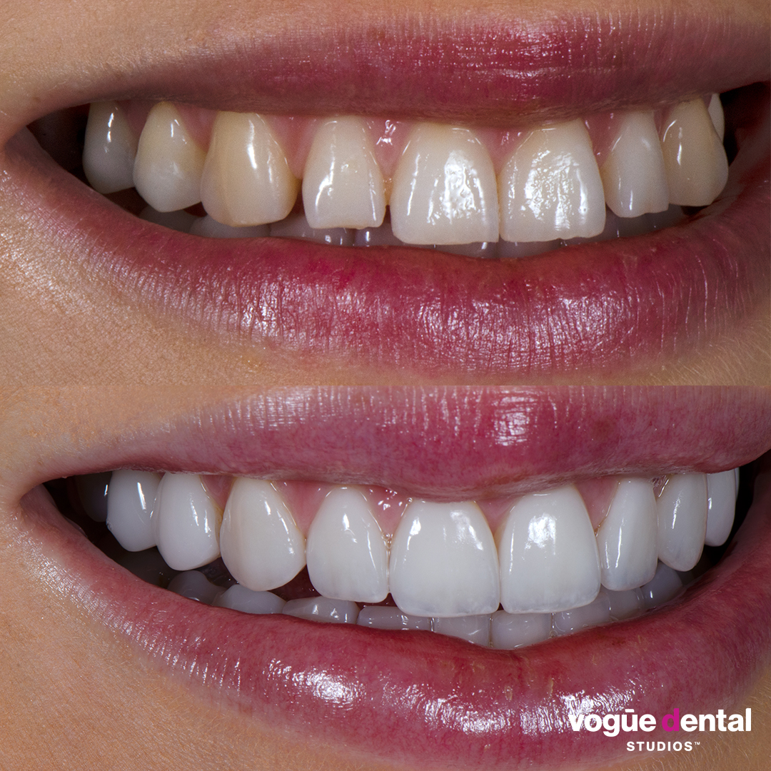 Before and after square teeth with porcelain veneers at Vogue Dental Studios - right teeth view Renee.