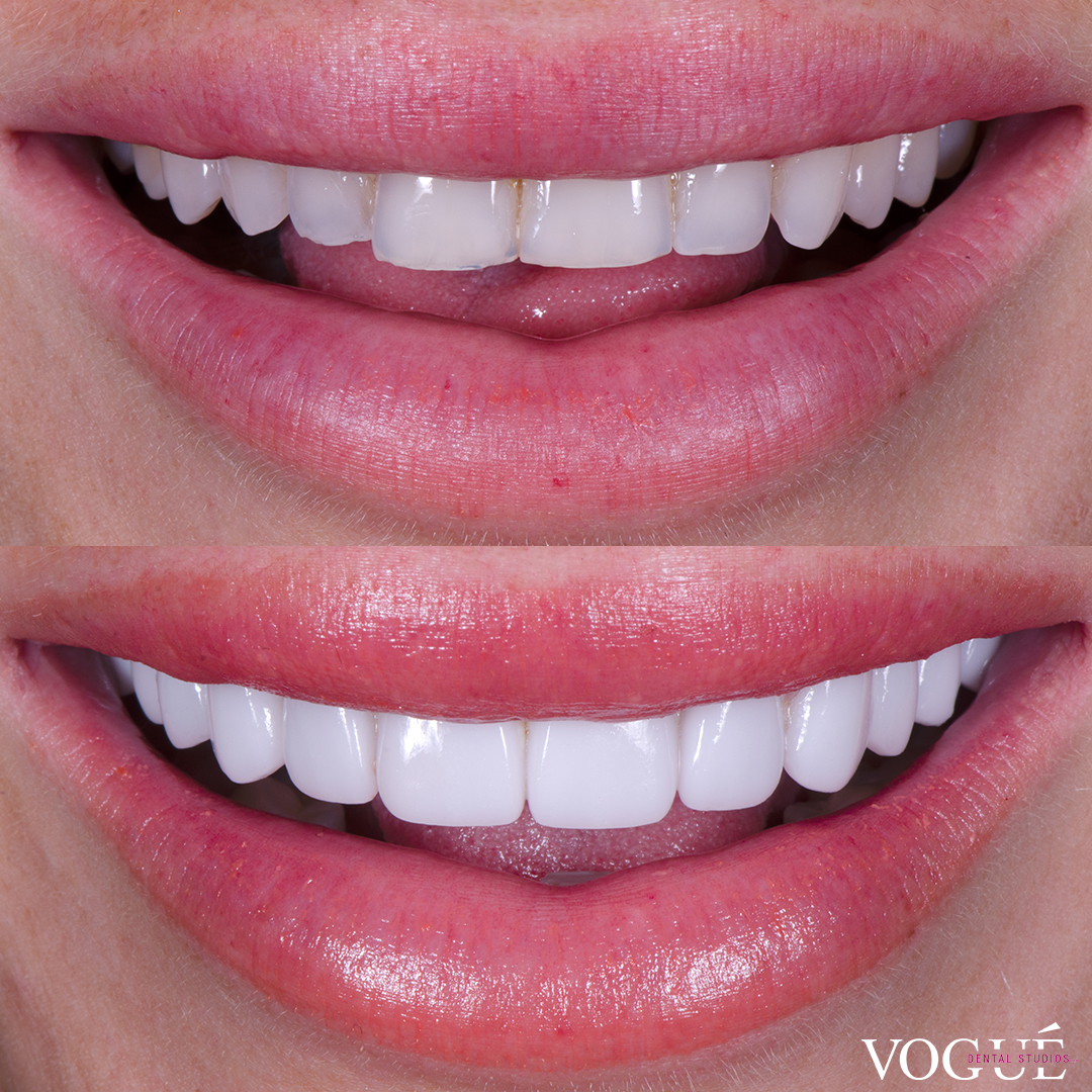 Before and after porcelain veneers smile makeover at Vogue Dental Studios - front teeth view Tash Herz.