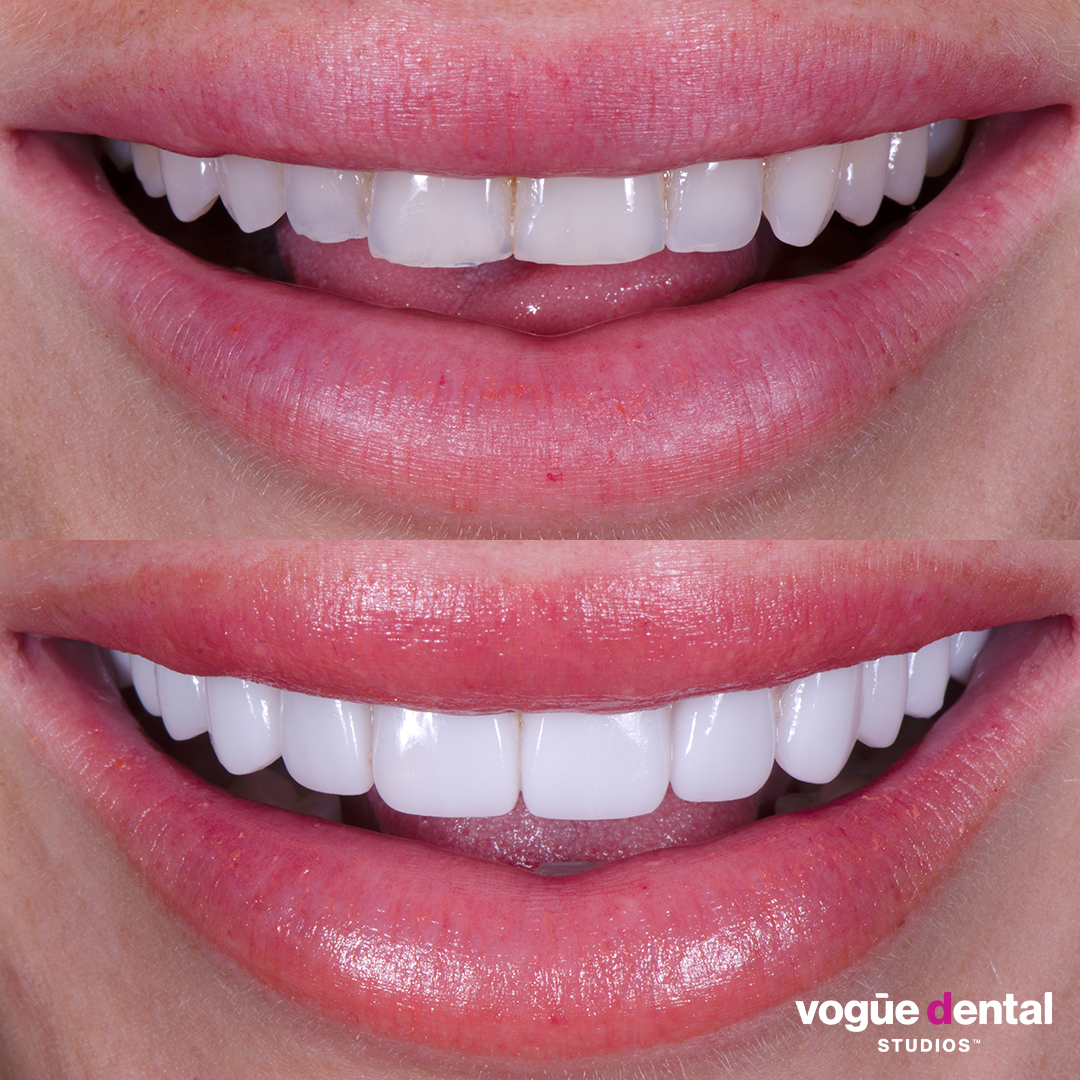 Before and after porcelain veneers smile makeover at Vogue Dental Studios - front teeth view Tash Herz.