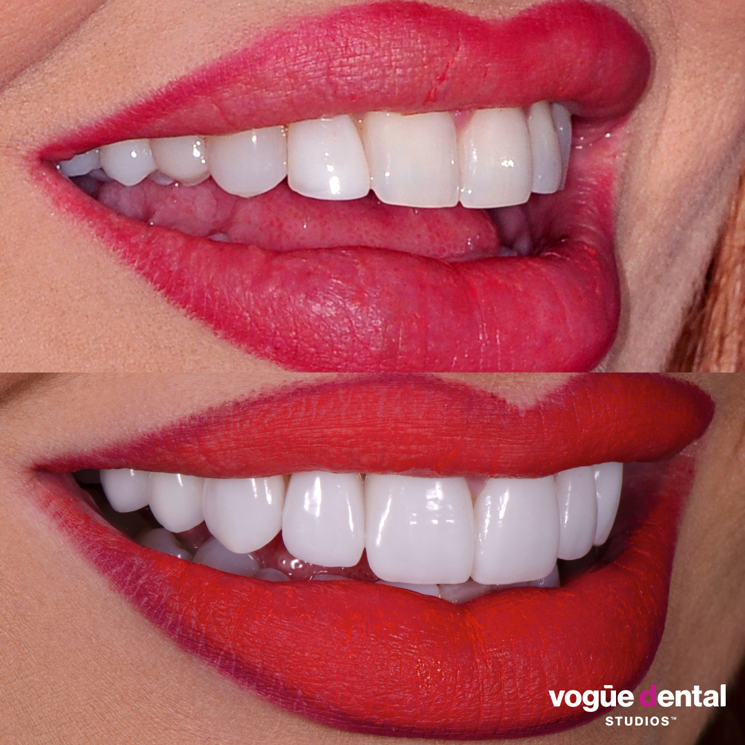 Before and after porcelain veneers at Vogue Dental Studios - front teeth view Sarah.