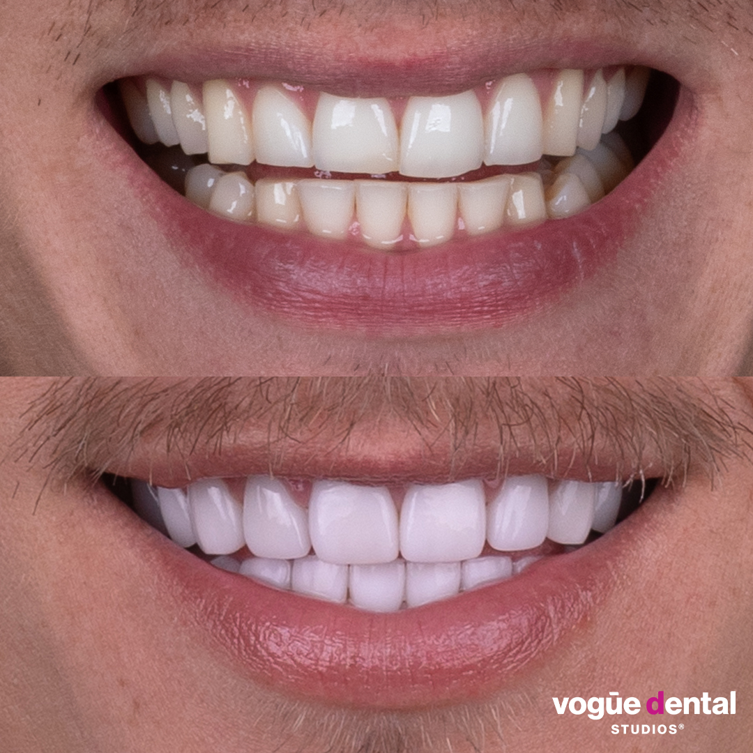 Ciarran Stott before and after smiling with teeth 20 picasso porcelain veneers