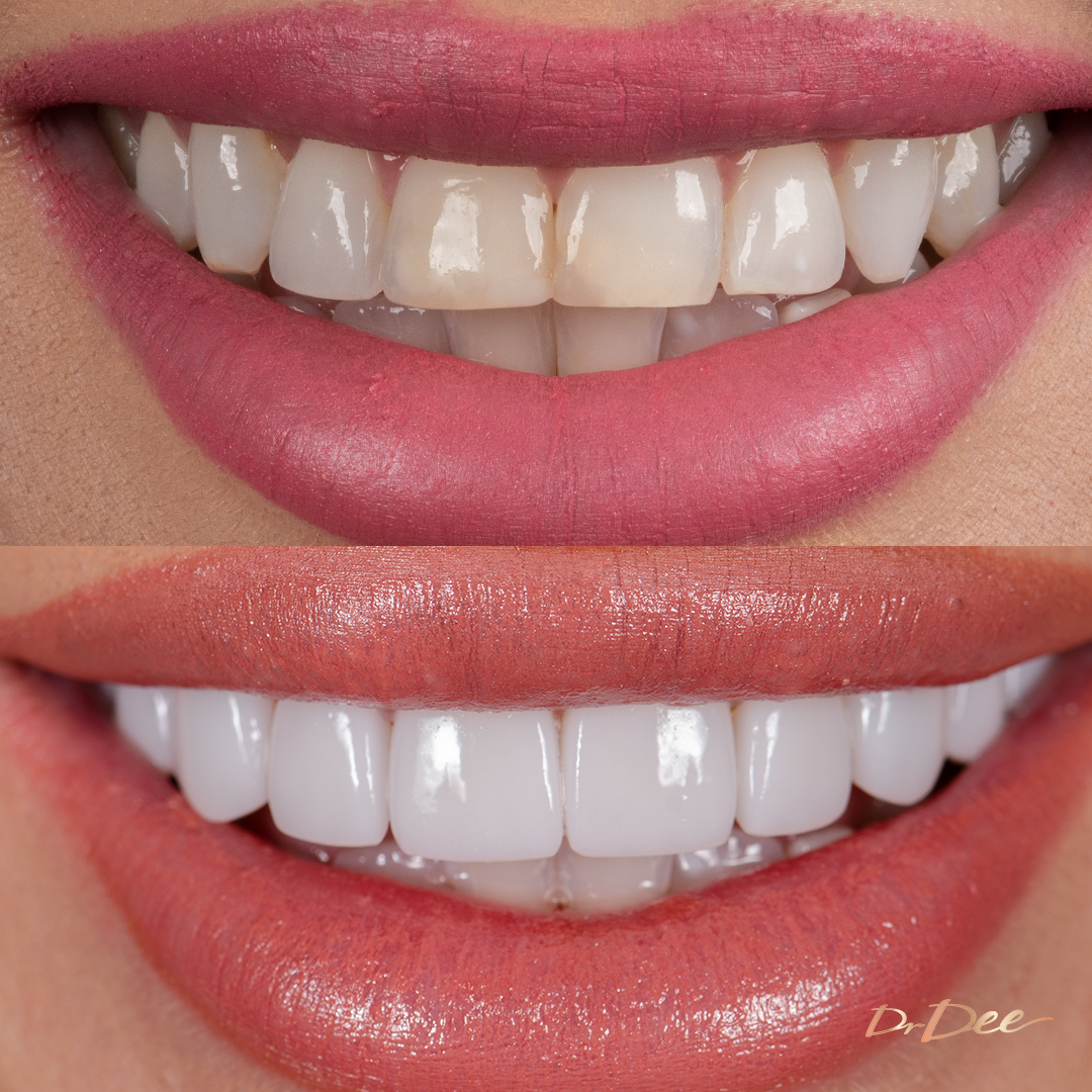 Before and after porcelain veneers at Vogue Dental Studios - front view Jessica