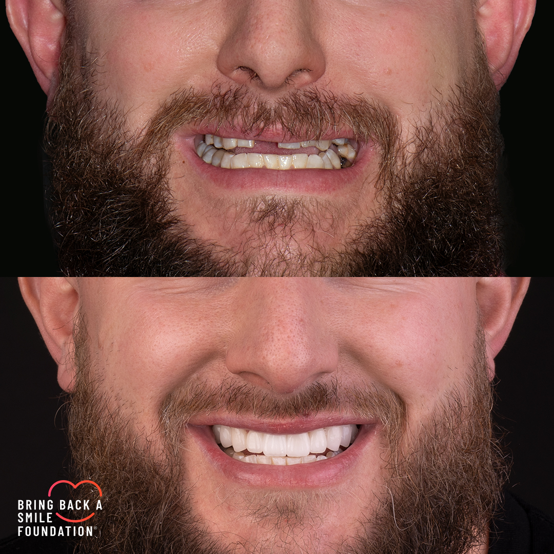 Craig missing front tooth before after smile makeover at Bring Back a Smile Foundation
