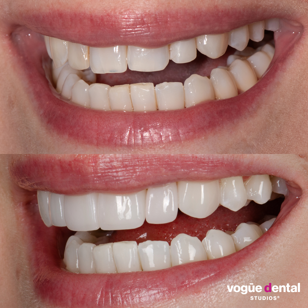 Before and after with Picasso Ultra Hybrid veneers at Vogue Dental Studios - side teeth view Eve.