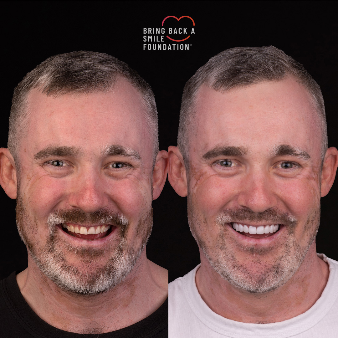 Curtis before after porcelain veneers at Bring Back a Smile Foundation