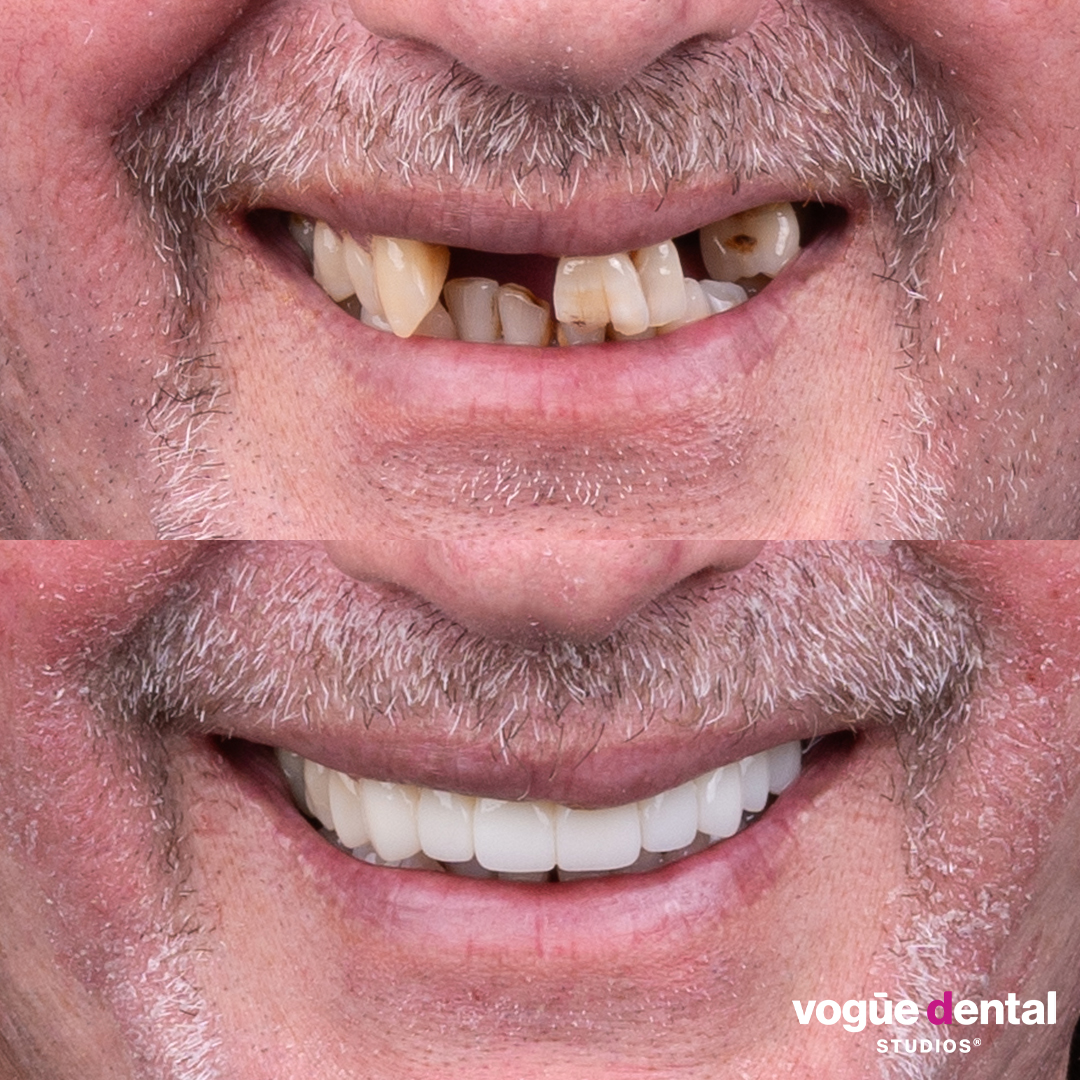 David several missing teeth smile restoration from smile makeover giveaway at Vogue Dental Studios