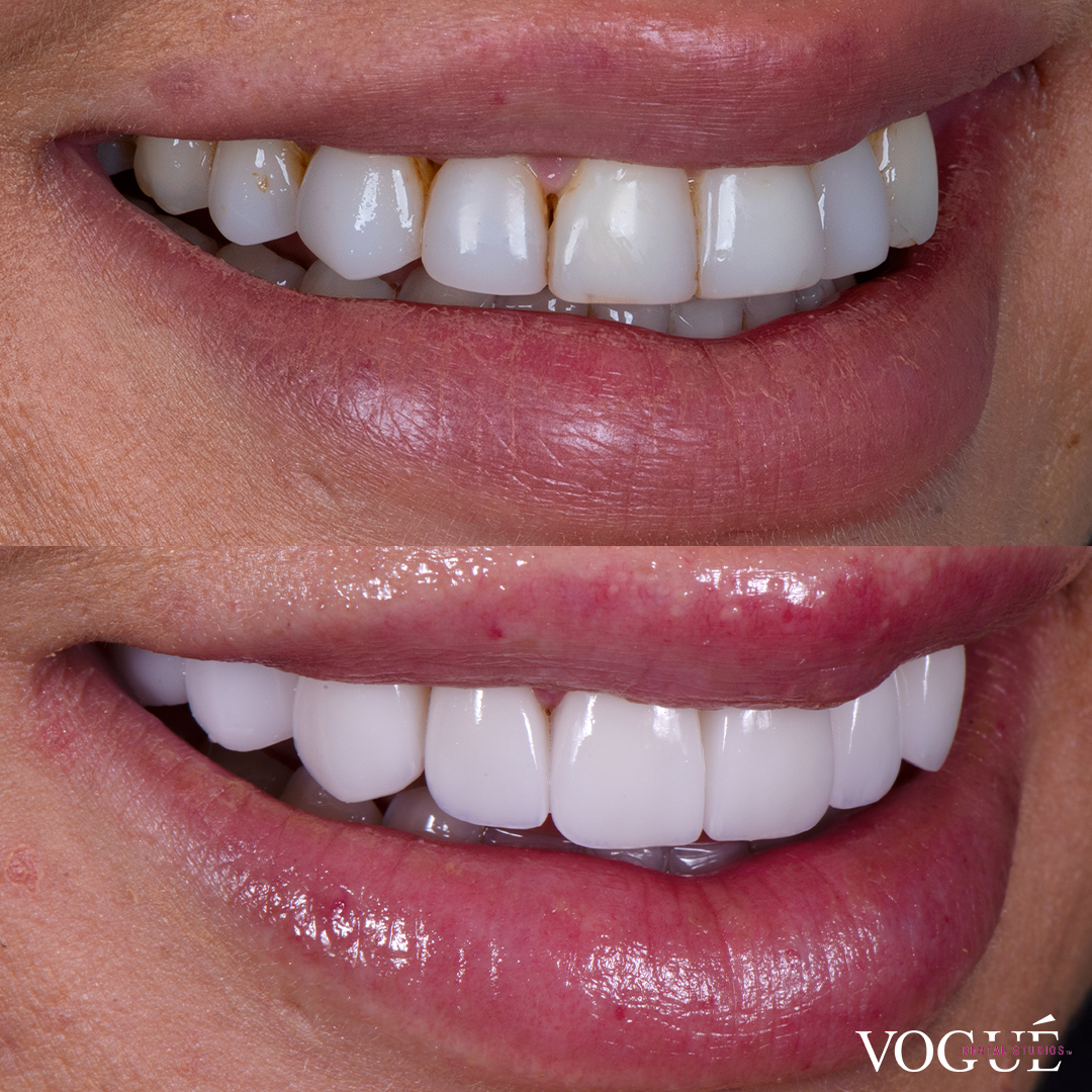 Before and after porcelain veneers at Vogue Dental Studios - Right Side View Jessica Brody The Bachelor