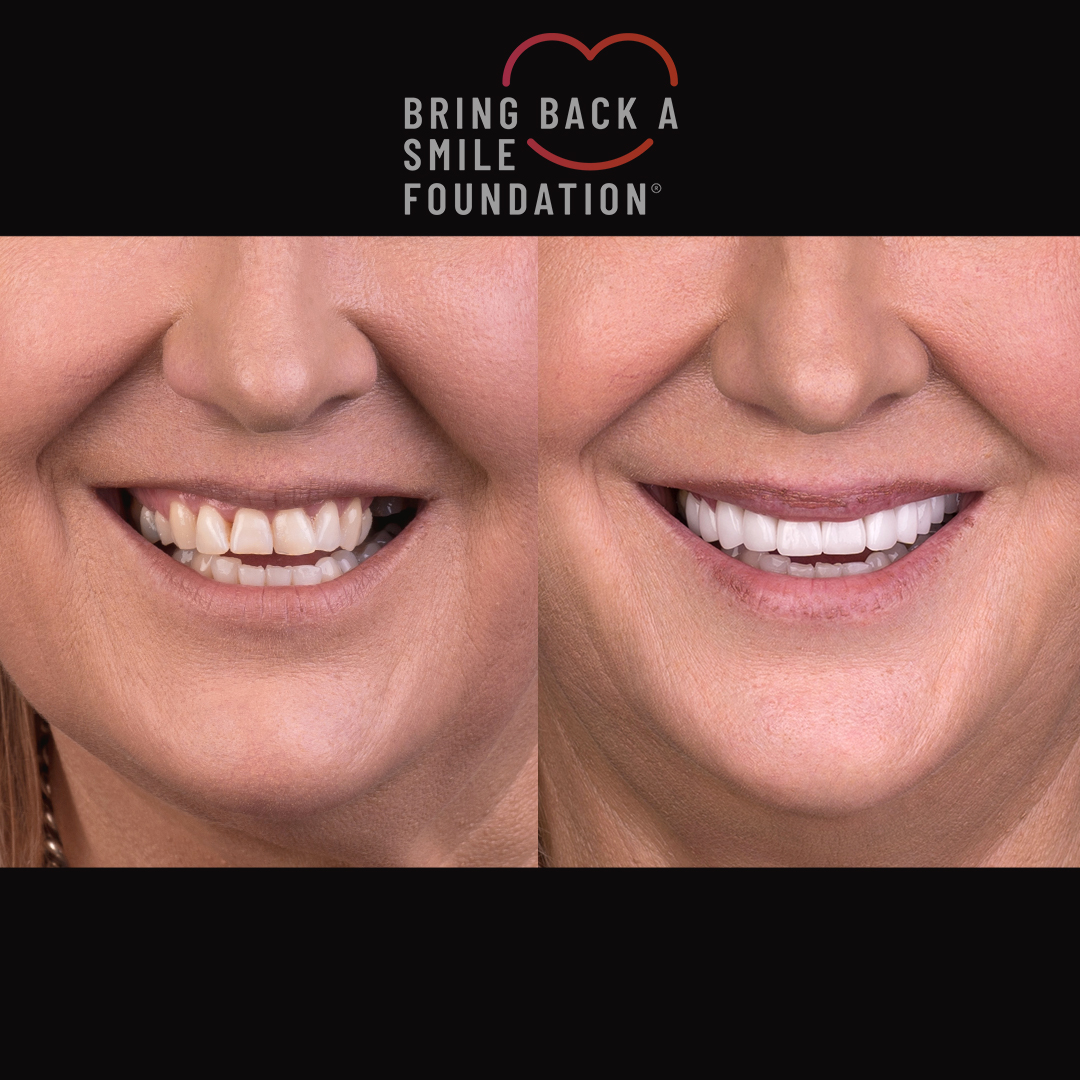 Bring Back a Smile Foundation before and after crowded teeth
