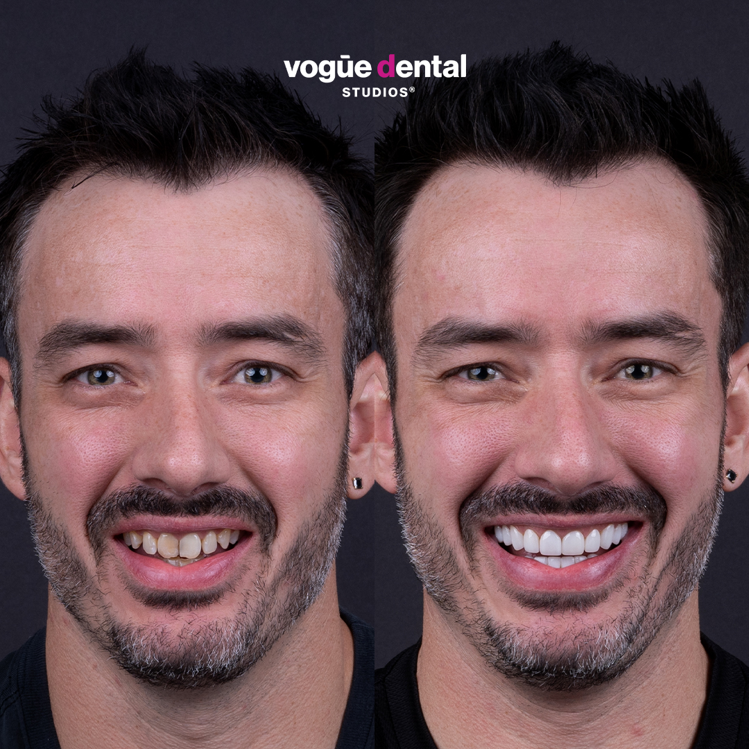 Before and after stained smile with porcelain veneers at Vogue Dental Studios - front face Steven