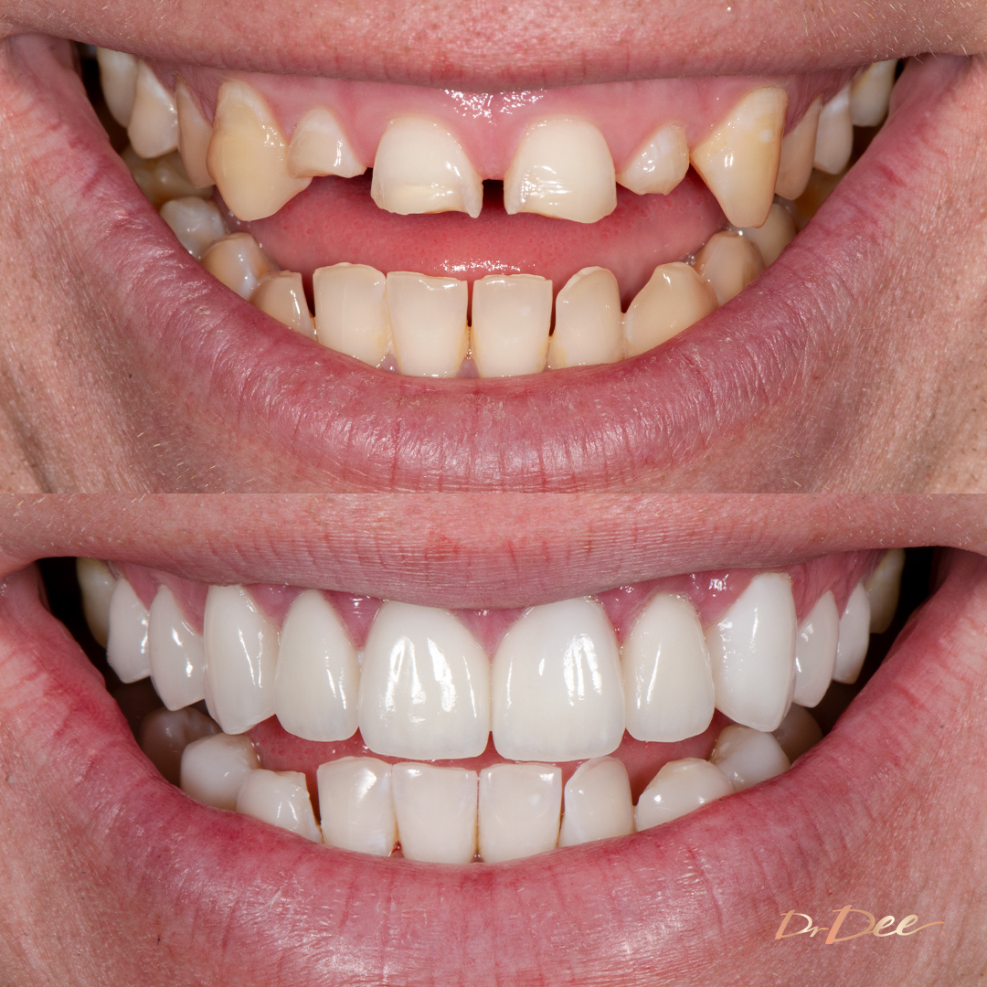 Before and after missing teeth with porcelain veneers at Vogue Dental Studios - front teeth view Dean A